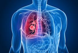 Tabagismo é a principal causa de câncer de pulmão e o que mais mata no Brasil e no mundo 1